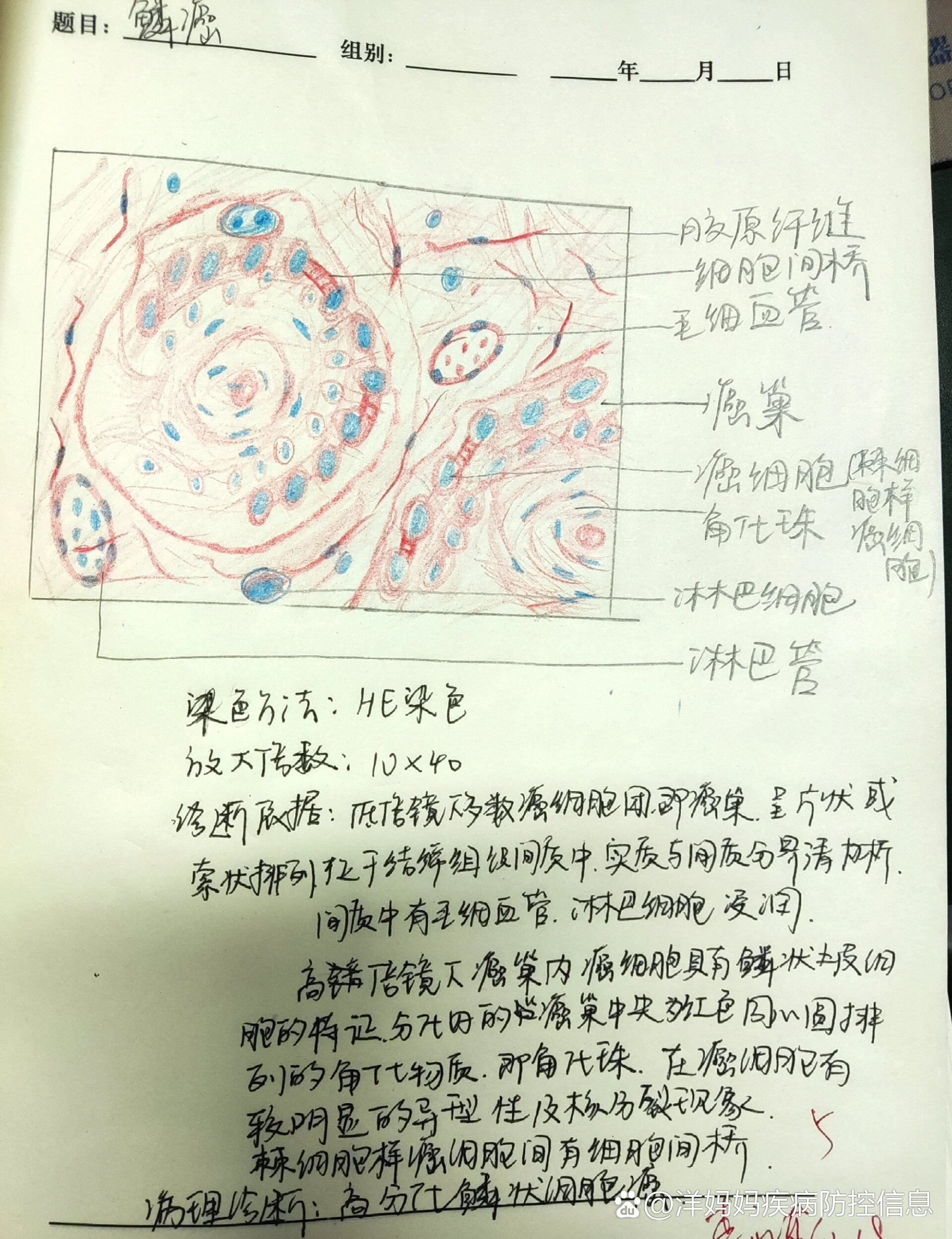 绒毛膜癌病理手绘图图片