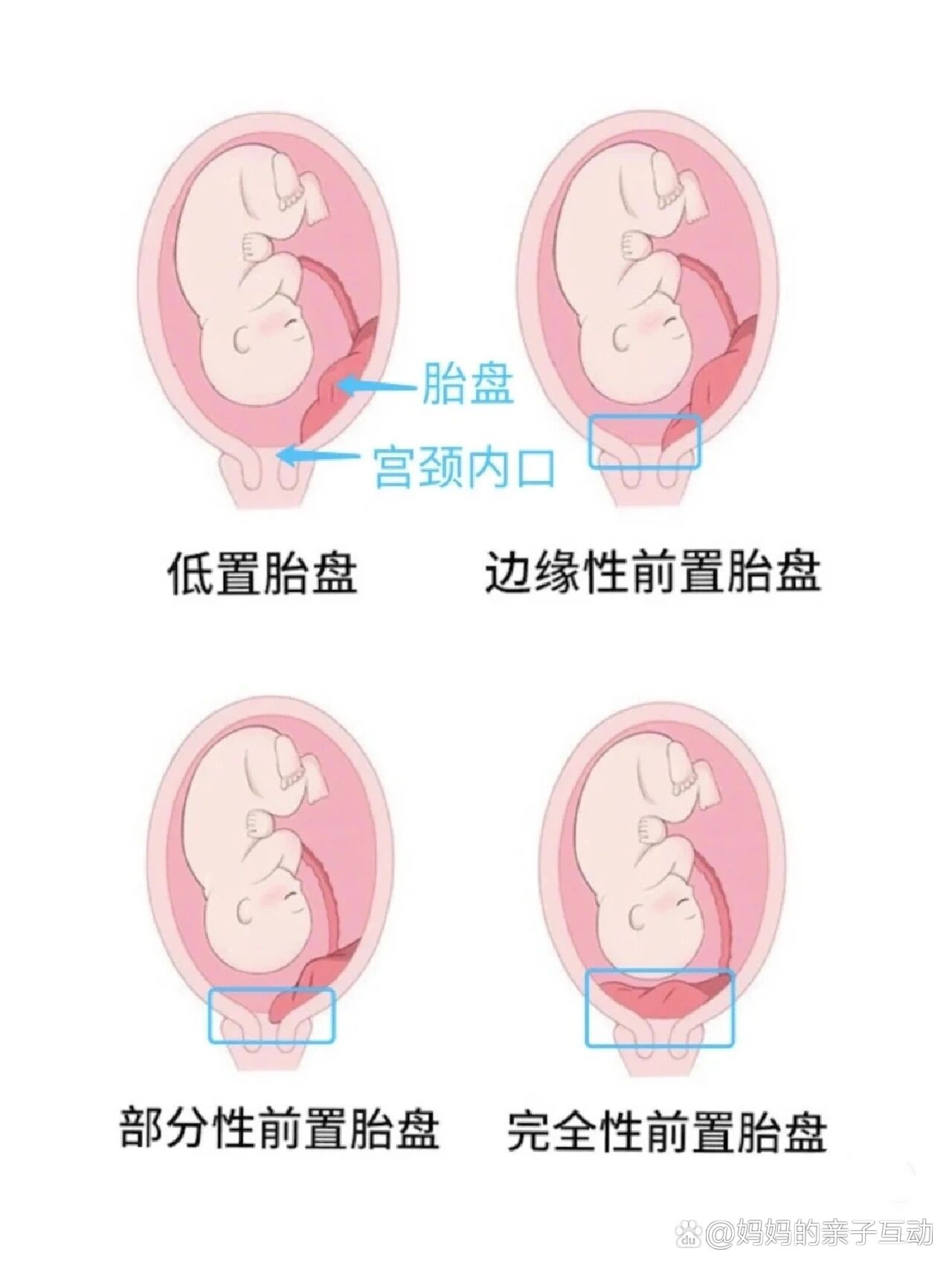 胎盘图片示意图图片