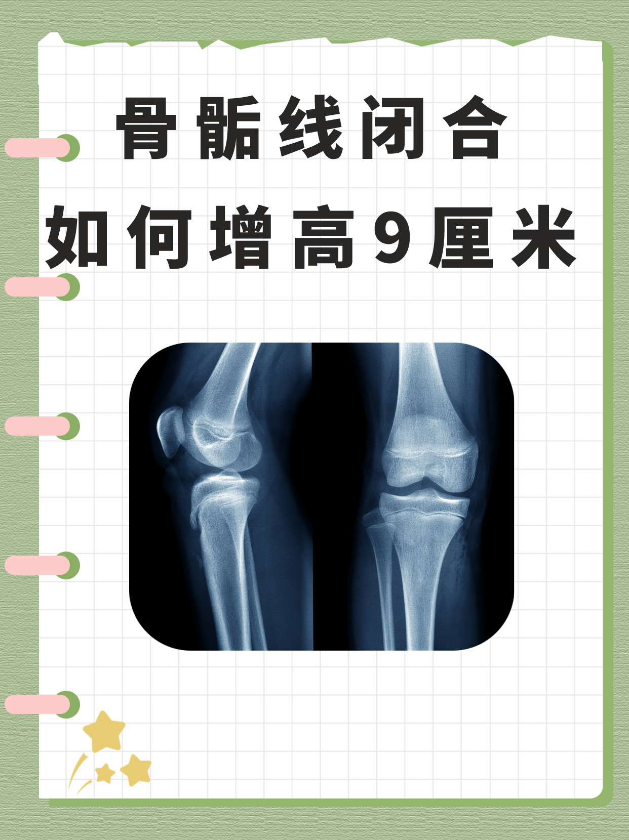 骨骺线闭合,我如何逆袭增高9厘米?
