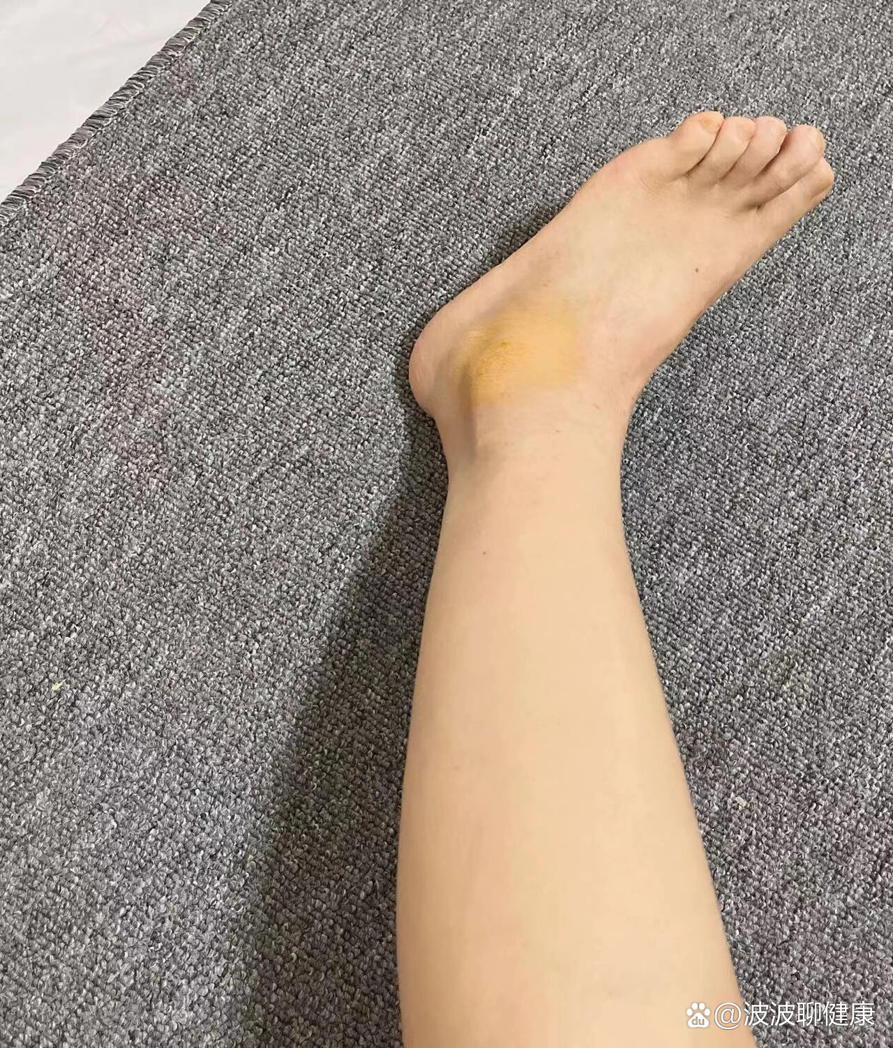 崴脚的第37天,不肿了