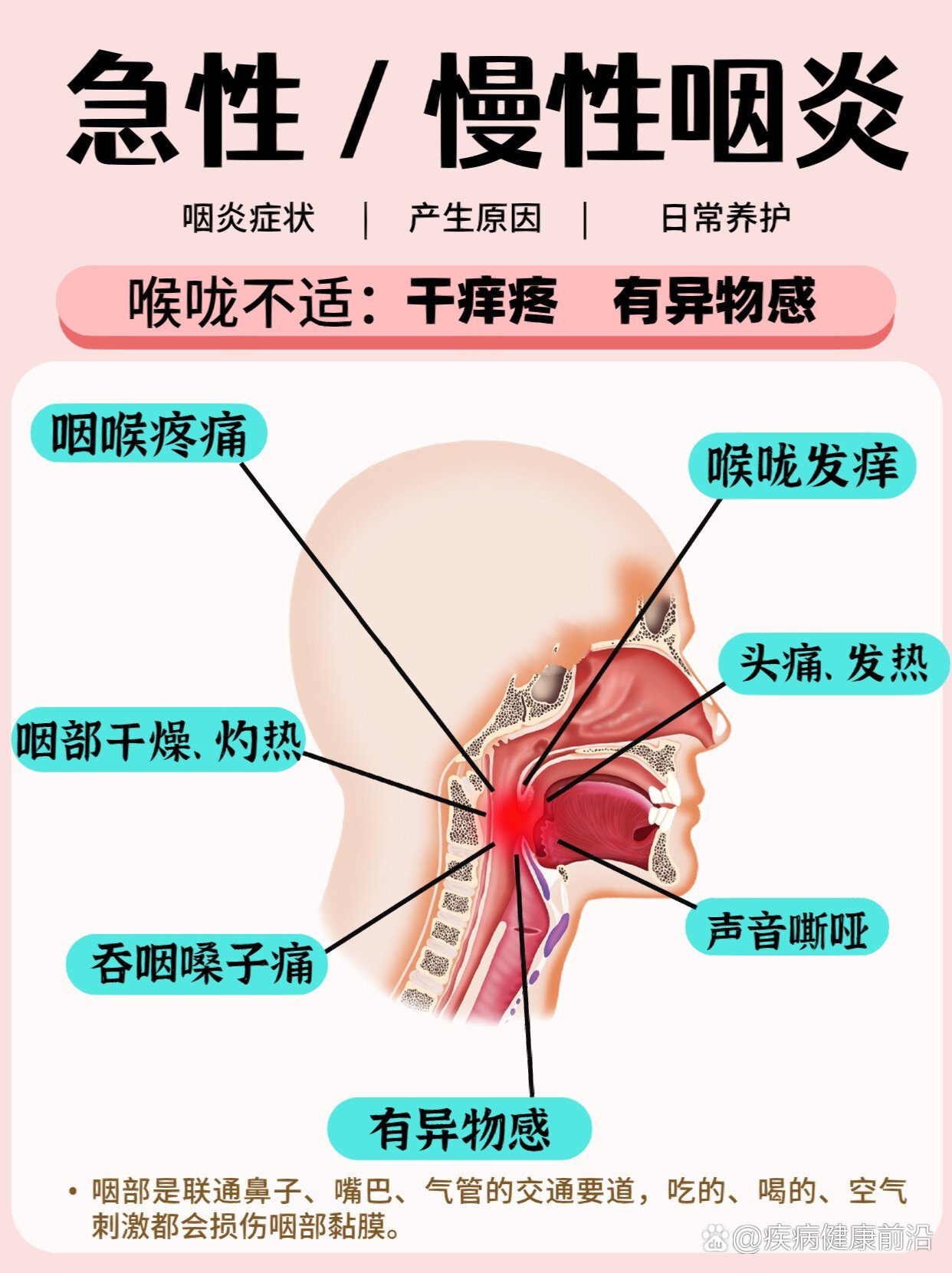 嗓子干痒痛有异物感🆘急性/慢性咽炎