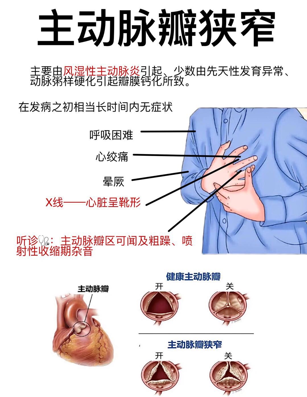 房室瓣钙化图片