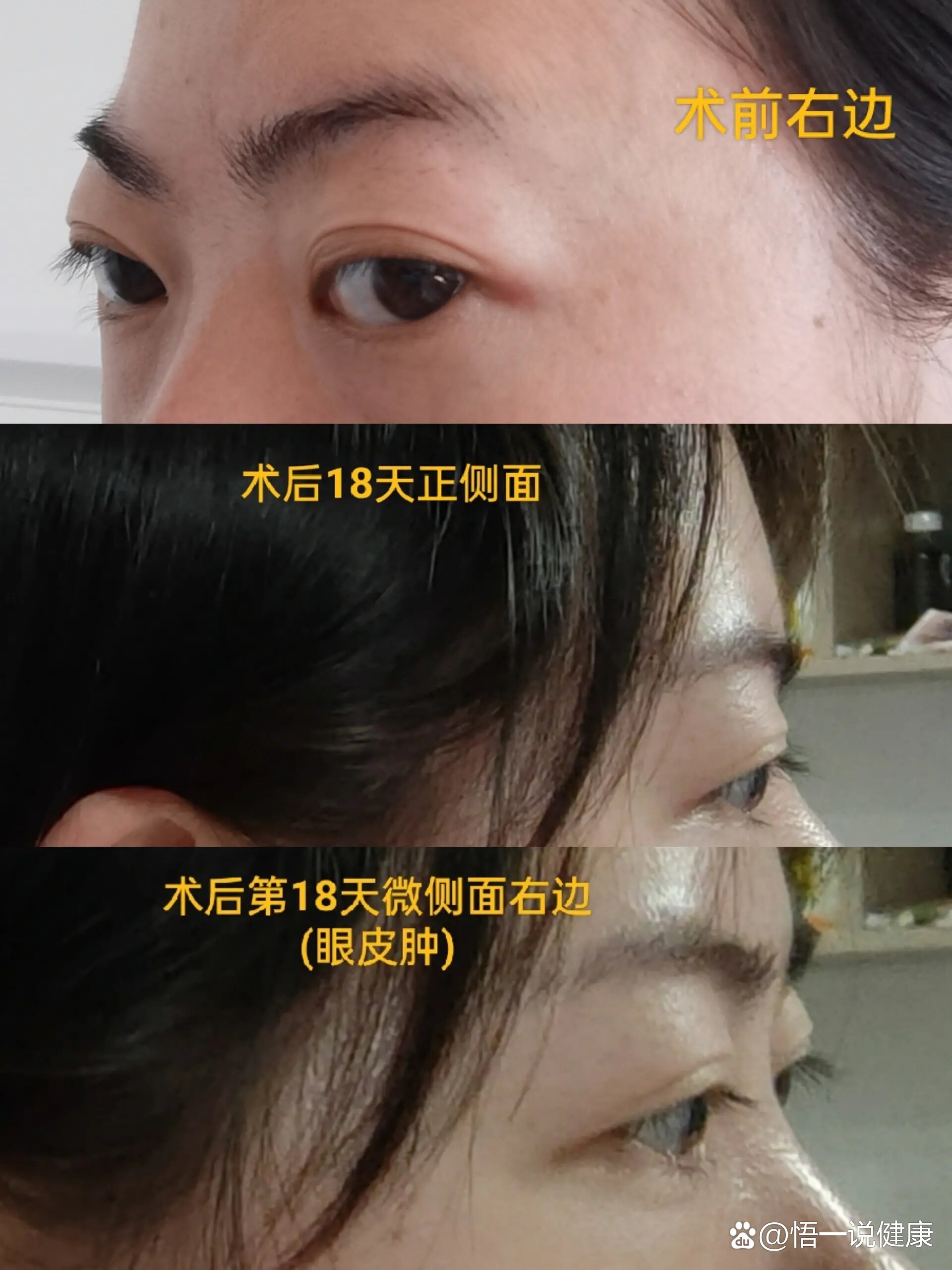 眼眶减压(突眼矫正)成功上岸第18天