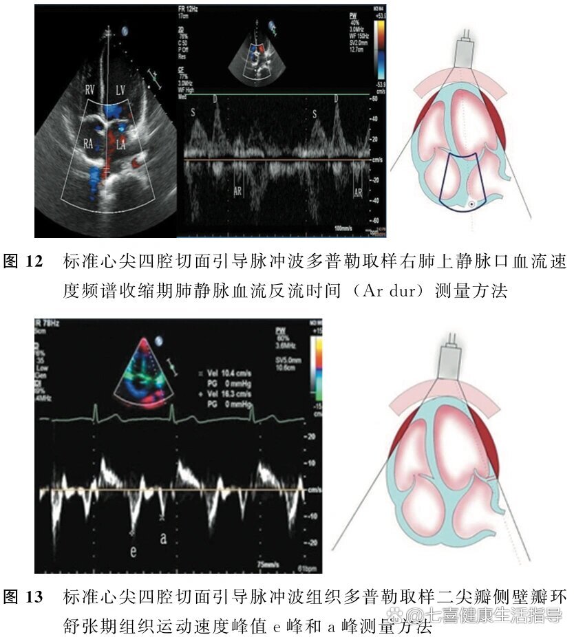 心脏超声5个标准切面图片