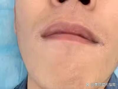 去胡青9915699215去除后能保持多久?