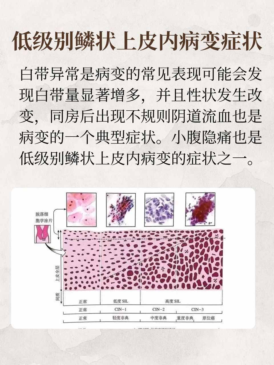 正常宫颈 鳞状上皮图片