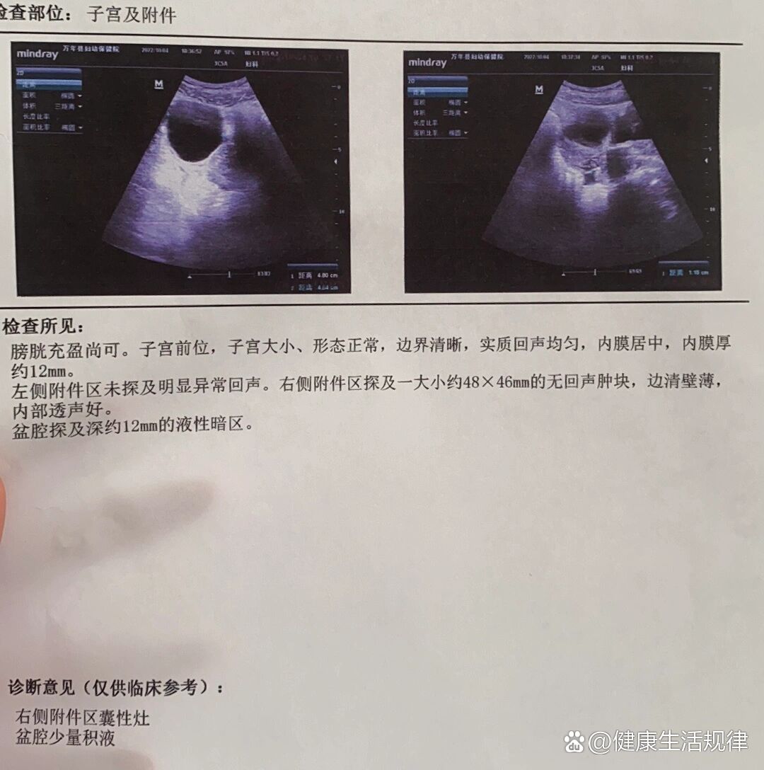 右附件区可见大小约59x45mm囊性暗区