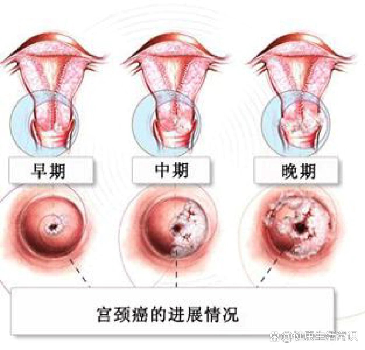 利普刀术后的宫颈图片图片