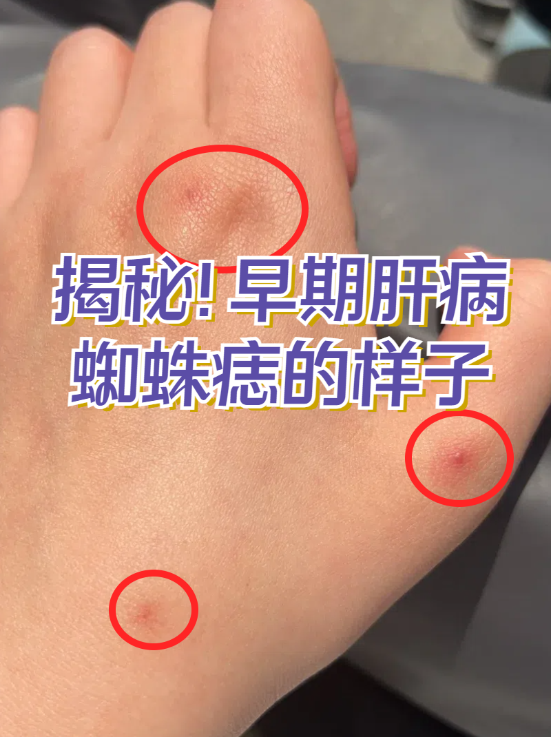 其实,蜘蛛痣是皮肤小动脉末端分支扩张所形成的,形状像蜘蛛的血管痣