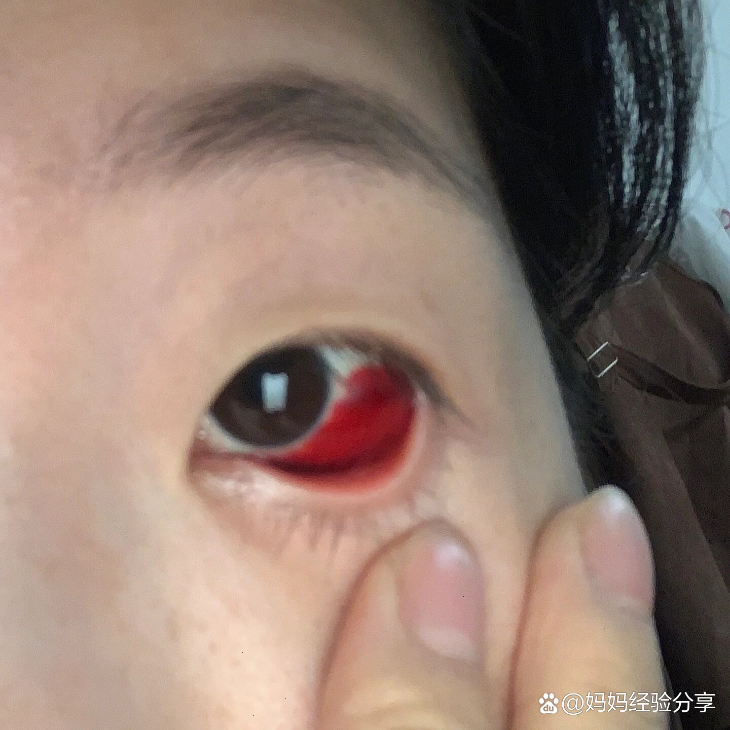 关于孕反眼睛充血有血块😭😭