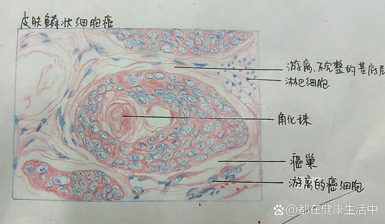 癌巢手绘图片