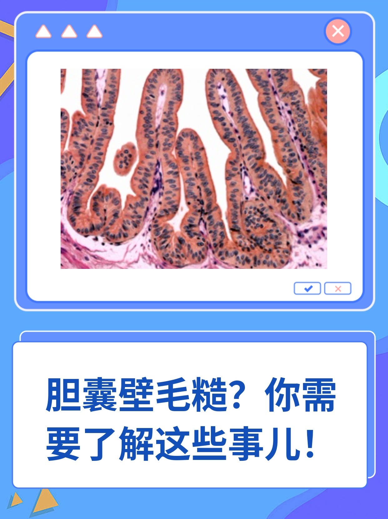 胆囊壁毛糙?你需要了解这些事儿
