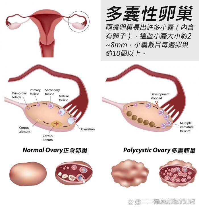 多囊为什么不容易怀孕