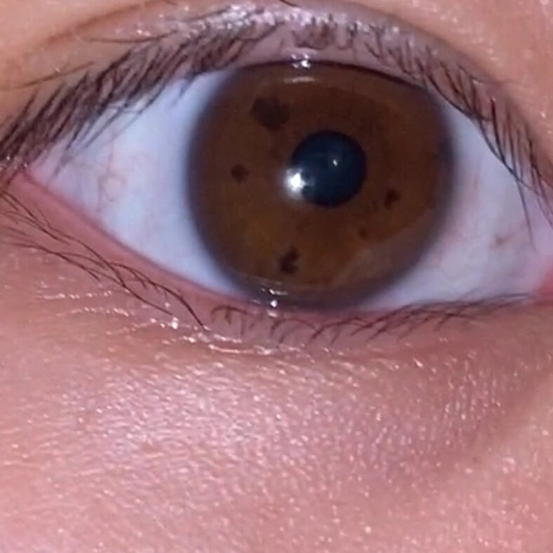 这种眼睛的虹膜正常么?