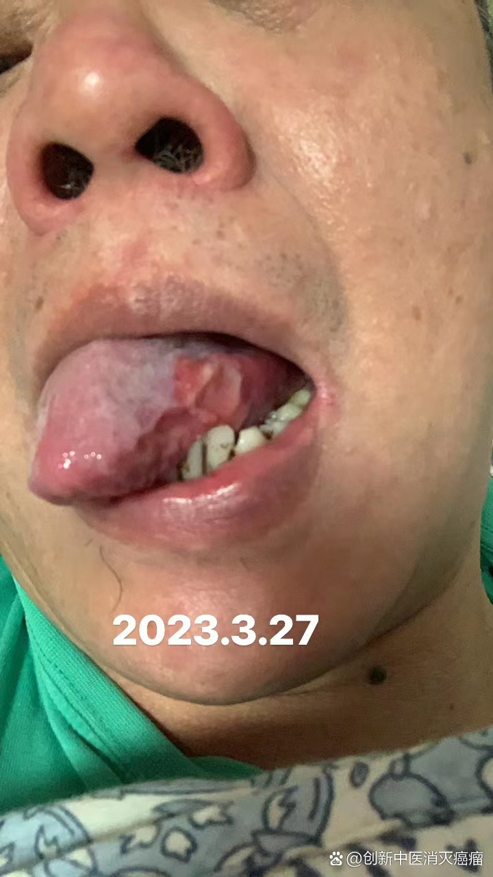 舌癌,仅仅一个月,就恢复一半了!