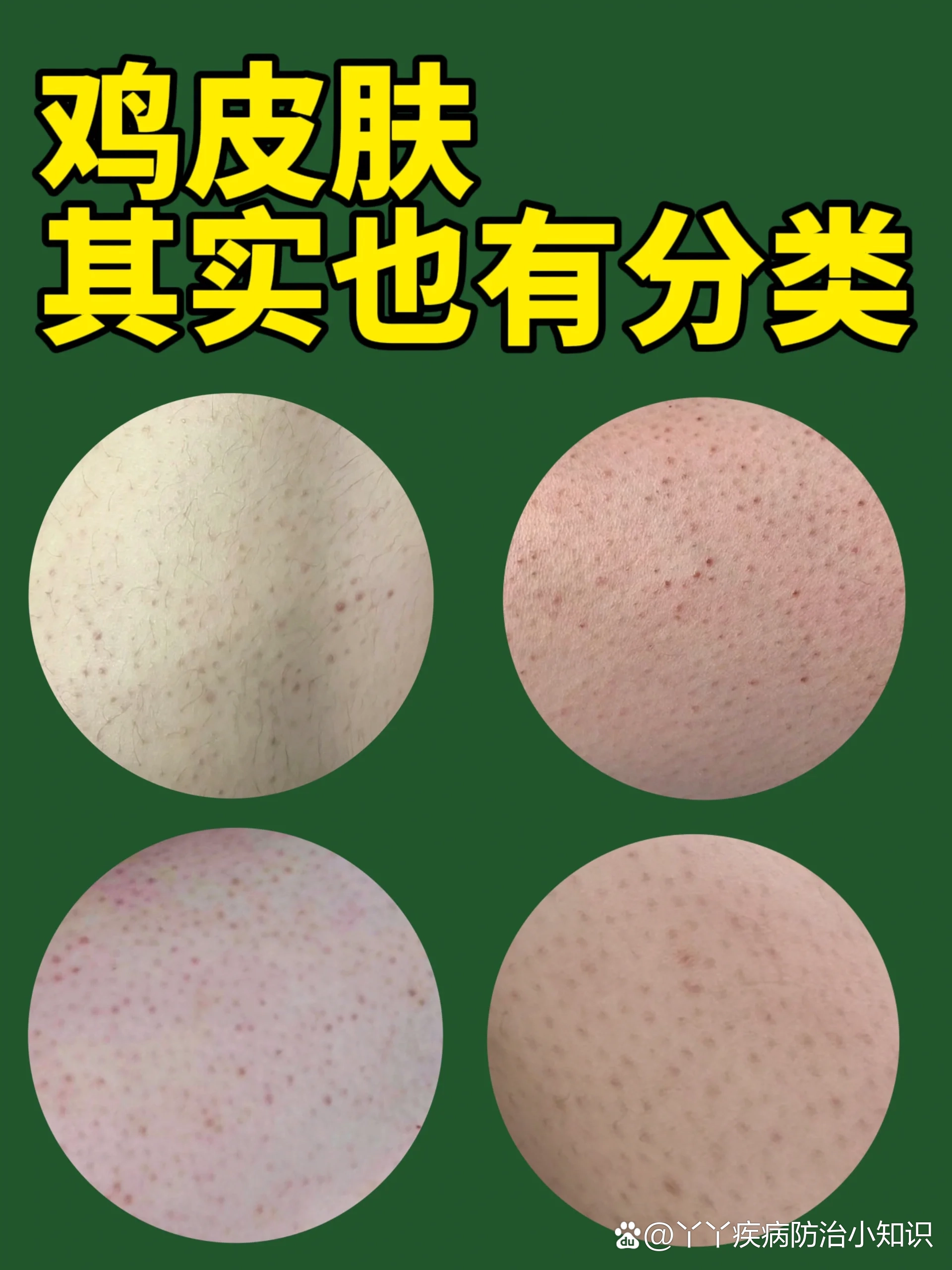 鸡皮肤的分类!