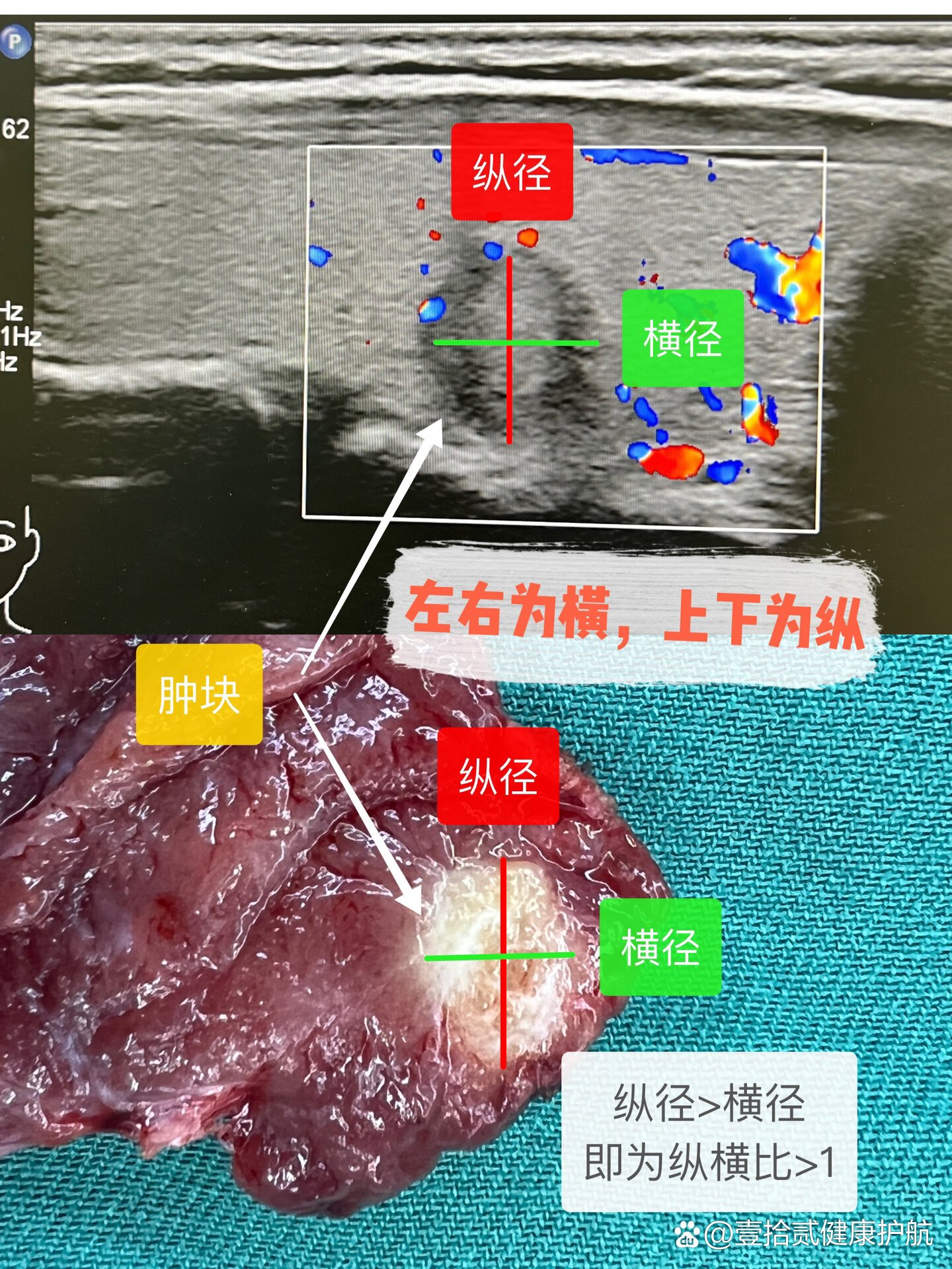 甲状腺上下动脉超声图图片