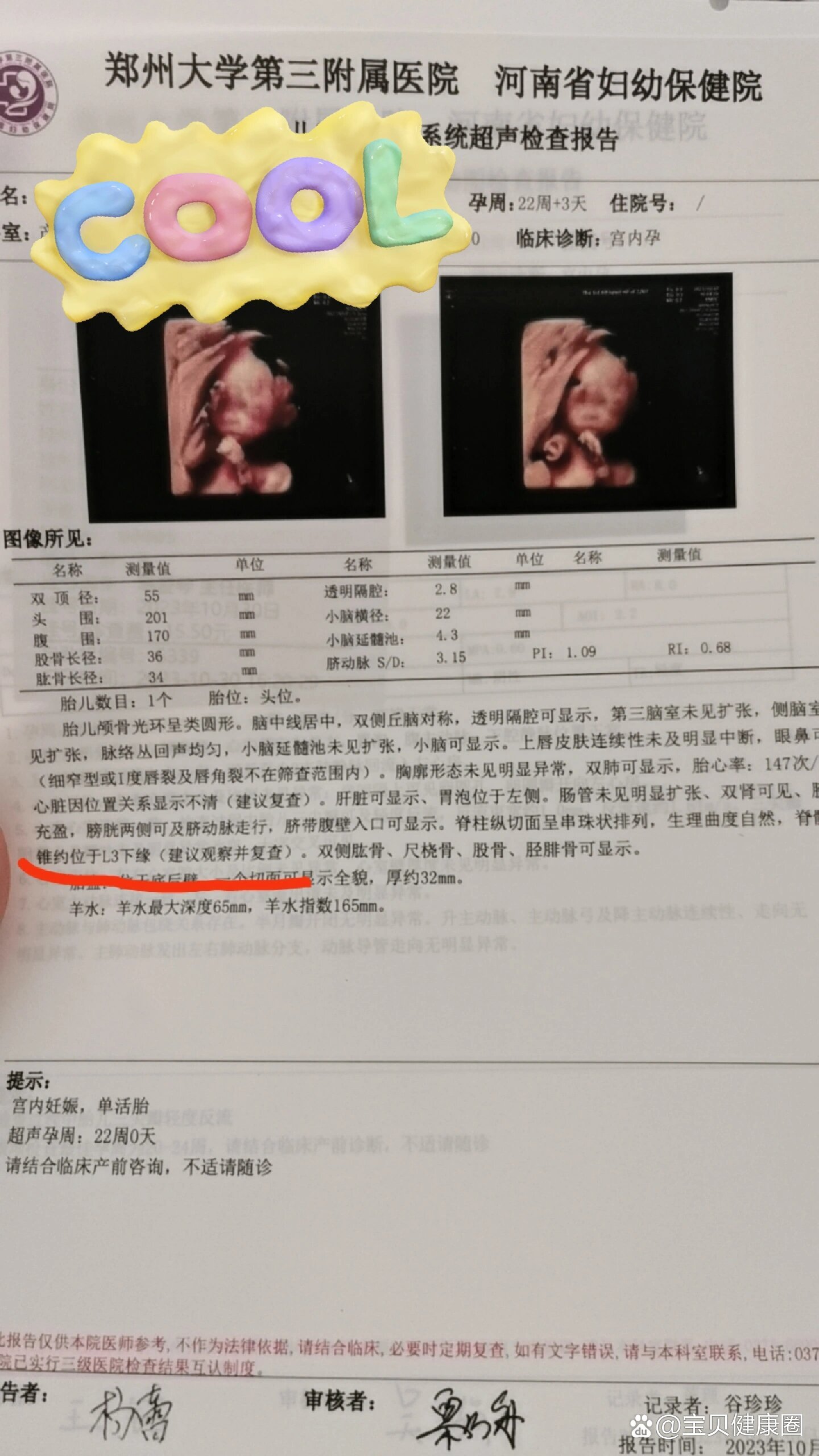 四维脊髓圆锥位置低