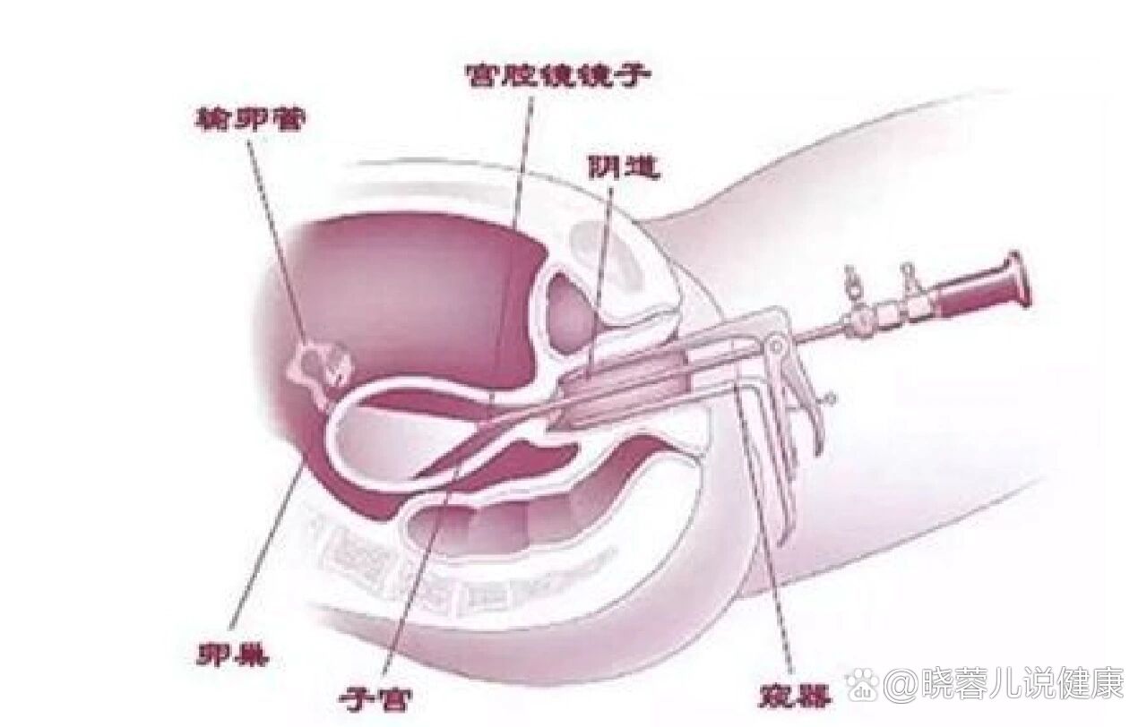 子宫内膜息肉 刮宫图片