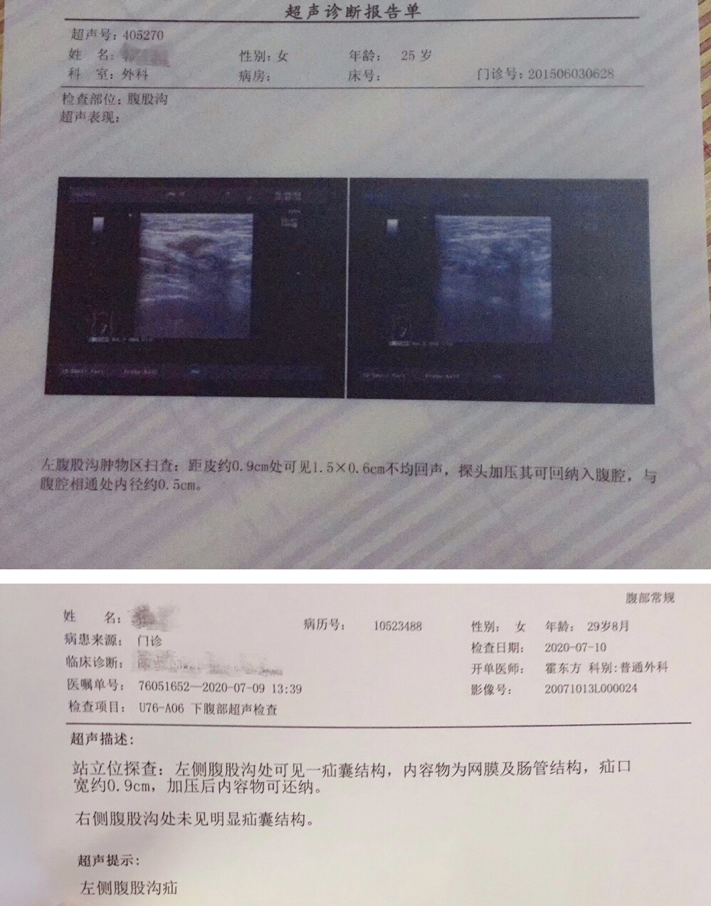 腹股沟疝超声描述图片