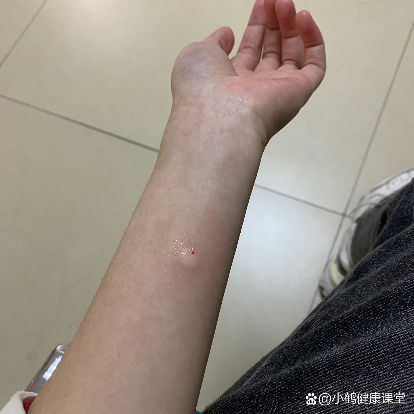 第一次打破伤风