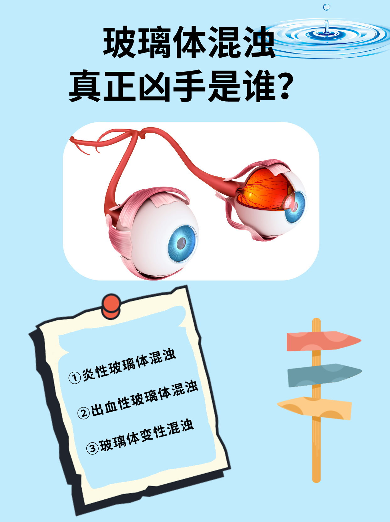 玻璃体混浊的真正凶手是谁?