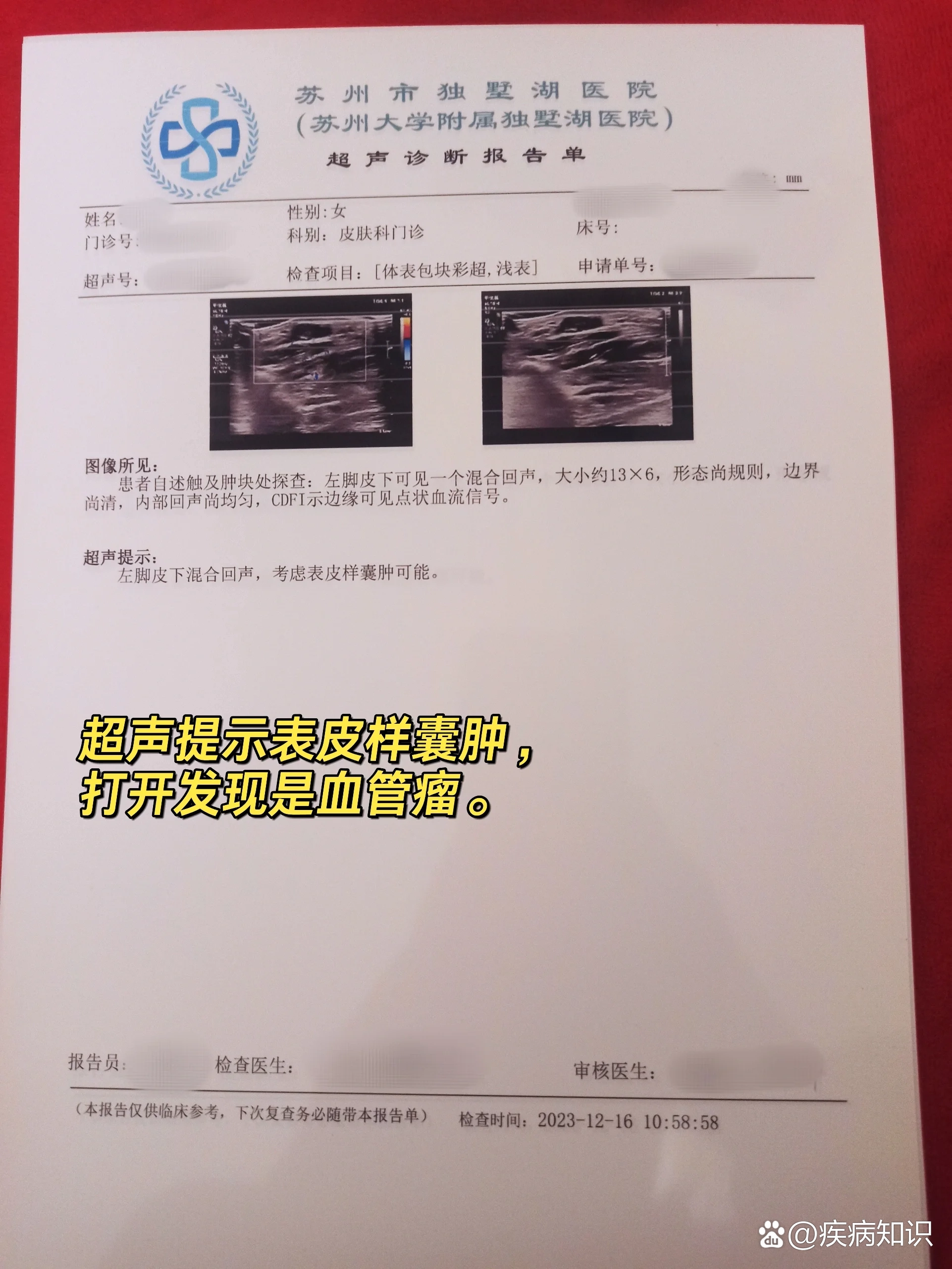 看边说:"是脂肪瘤";接着看脚,说:"是个混合回声包块,看样子像是囊肿"