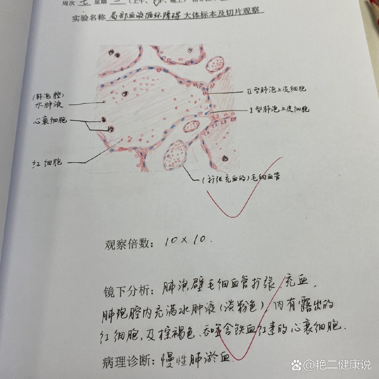 慢性肺淤血切片手绘图图片