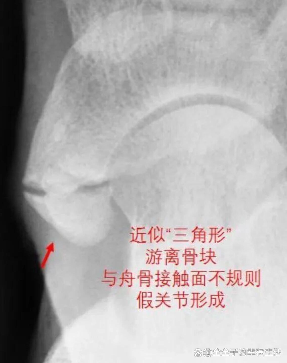  br>很多人有足弓内侧的突起,摸起来硬硬的,这就是足舟骨的位置.