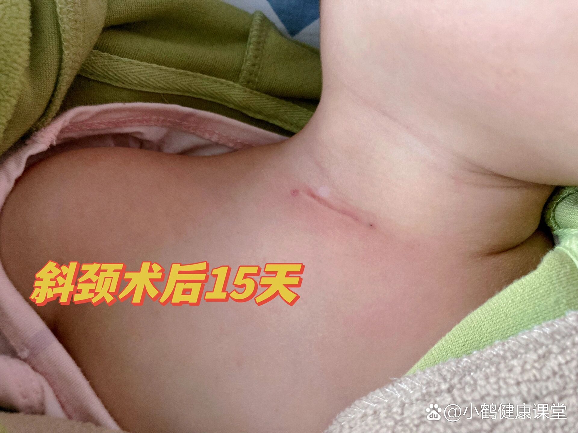 斜颈手术第15天