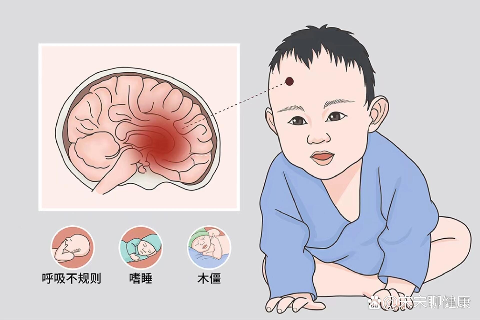 角弓反张的早期表现图片