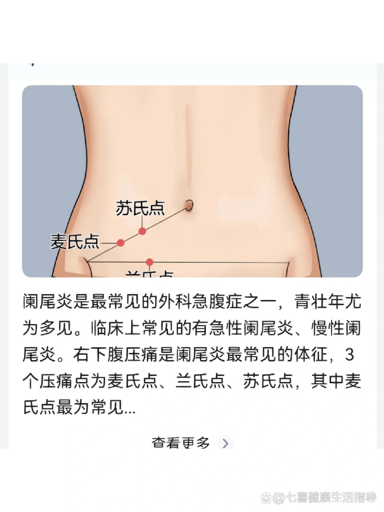 右下腹麦氏点图片