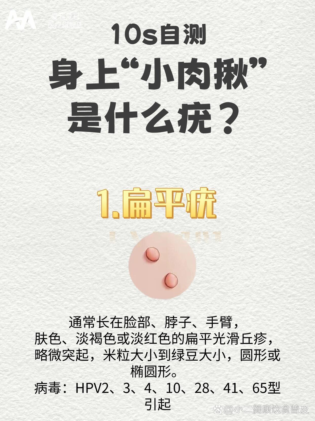 只能干着急,0269♀15其实是感染了hpv病毒04皮肤才会长疣