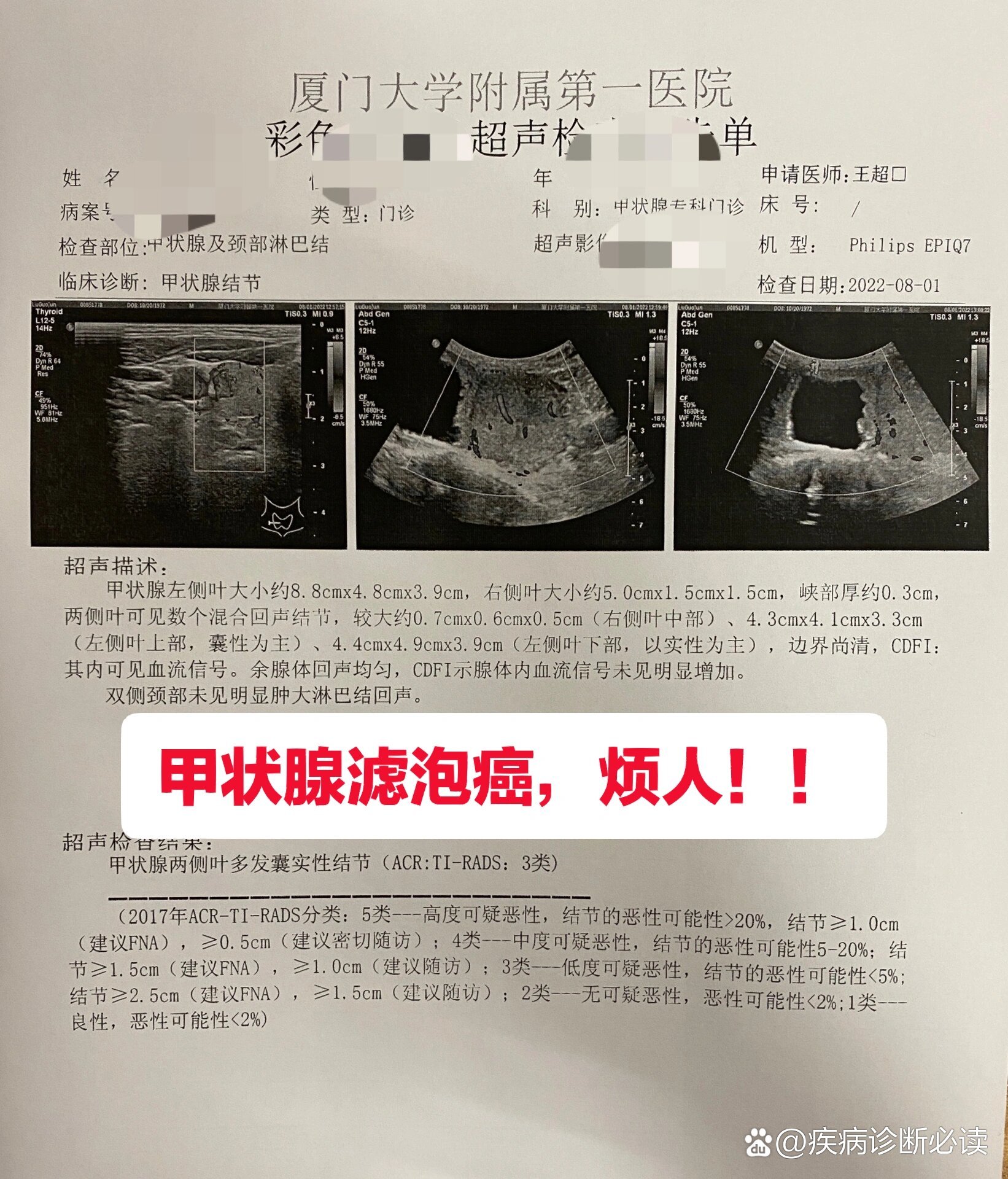 一例典型的二刀甲状腺滤泡癌