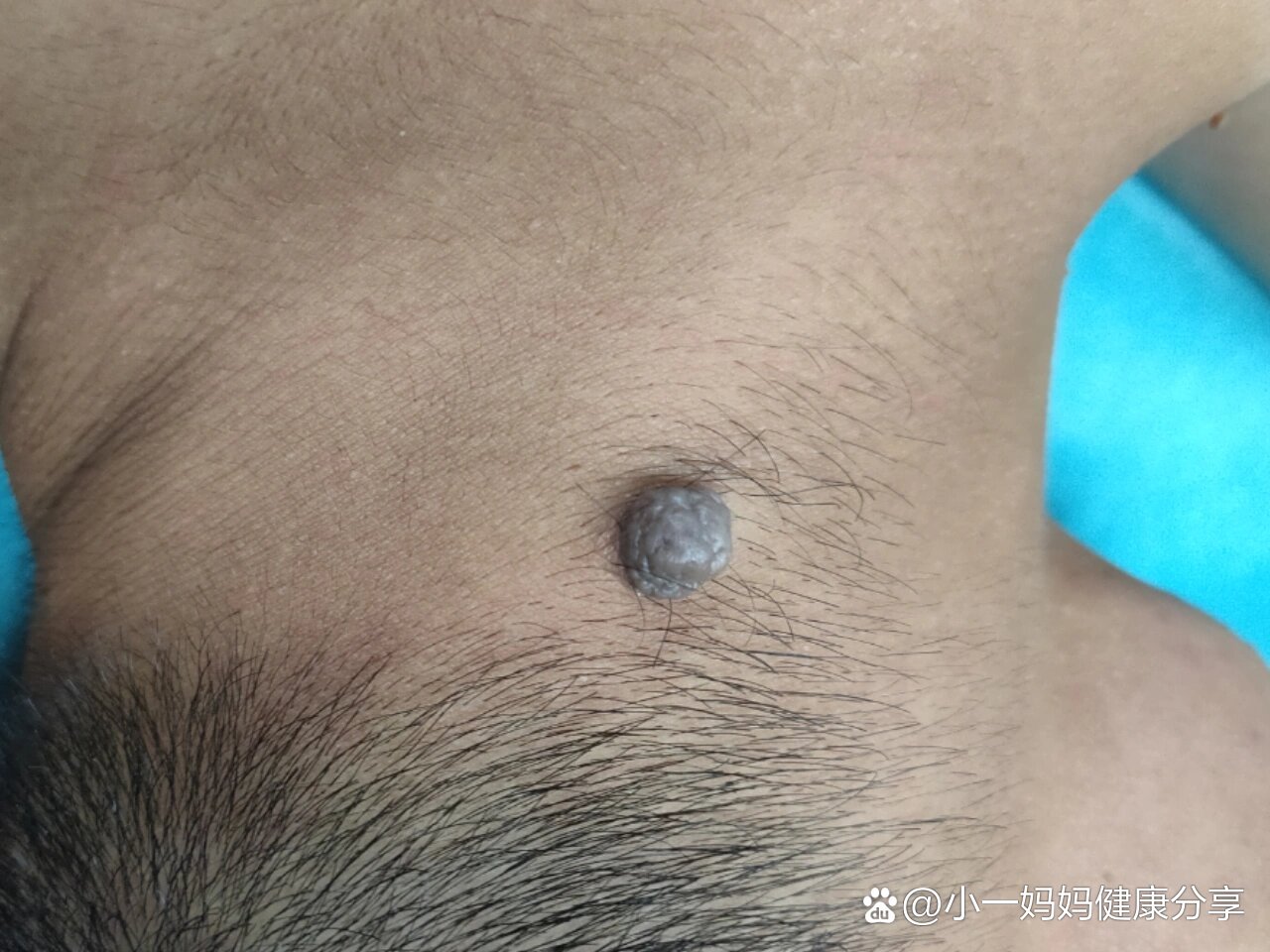 头皮凸起来一个肿物