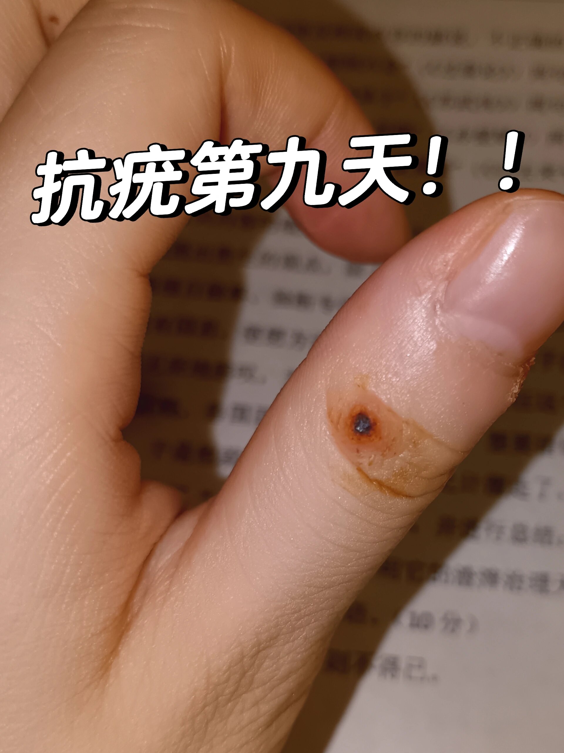 治疗寻常疣!