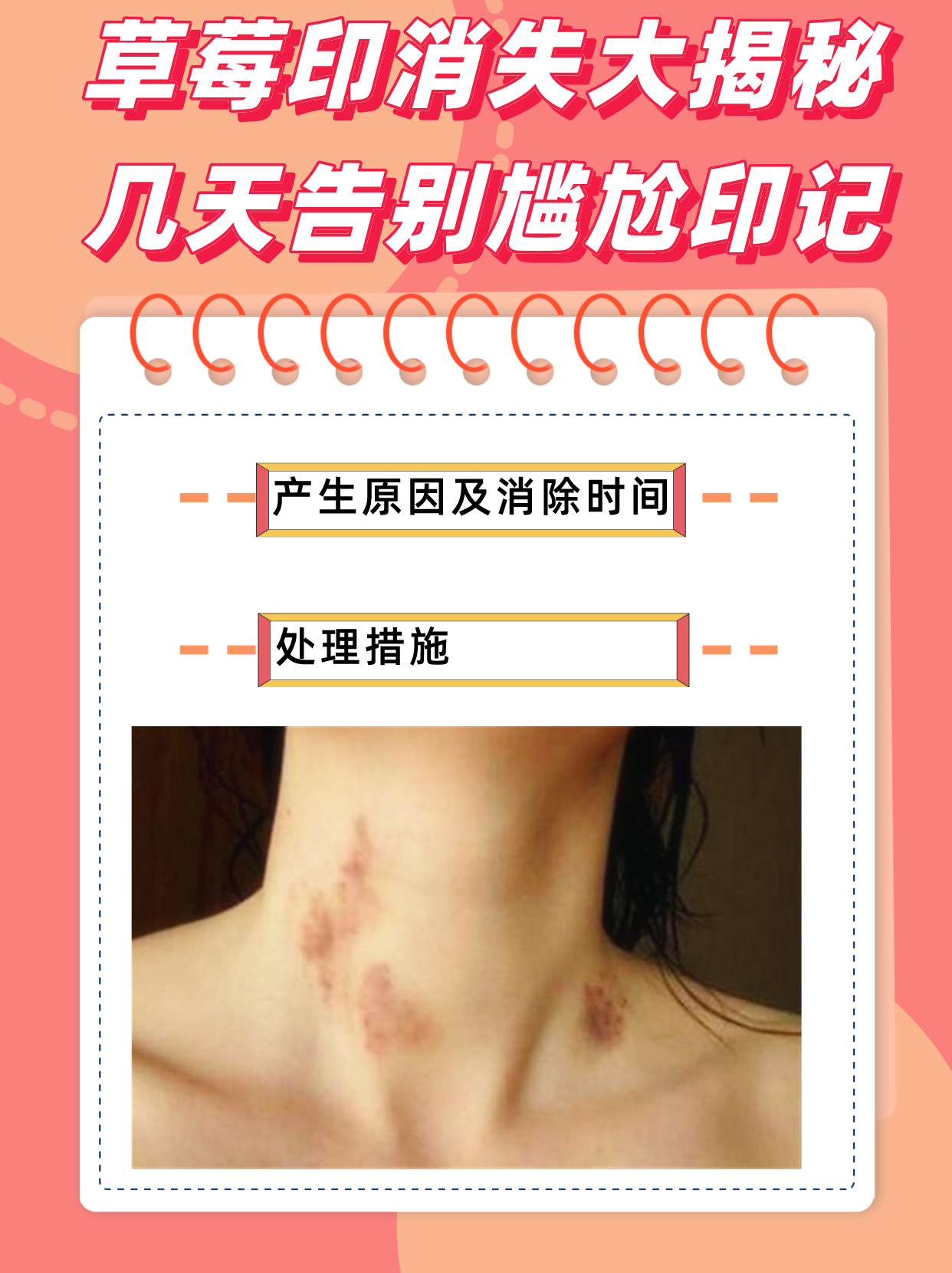 草莓印消失大揭秘:几天告别尴尬印记!