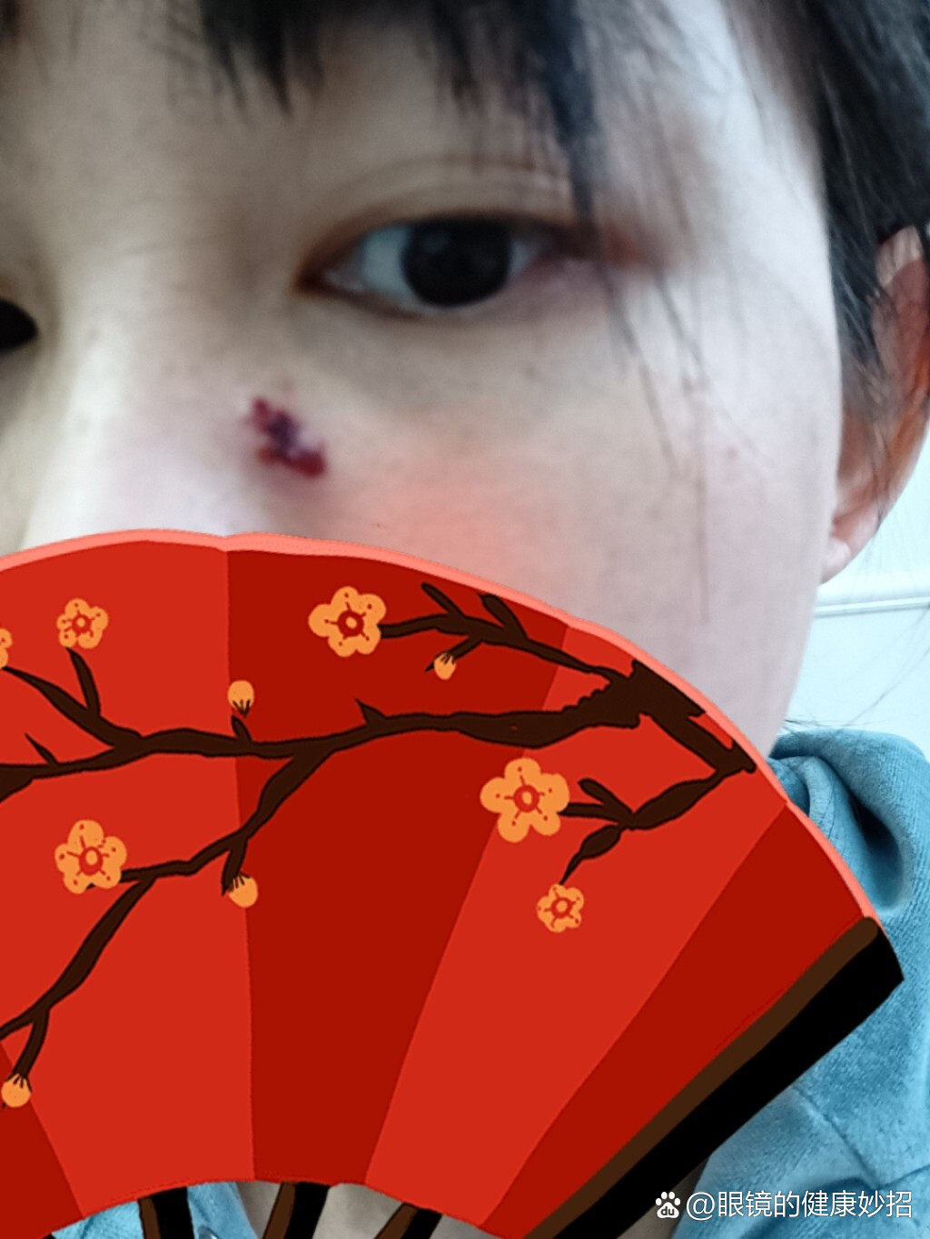 疖肿第八天,全部结痂,心情美美哒!