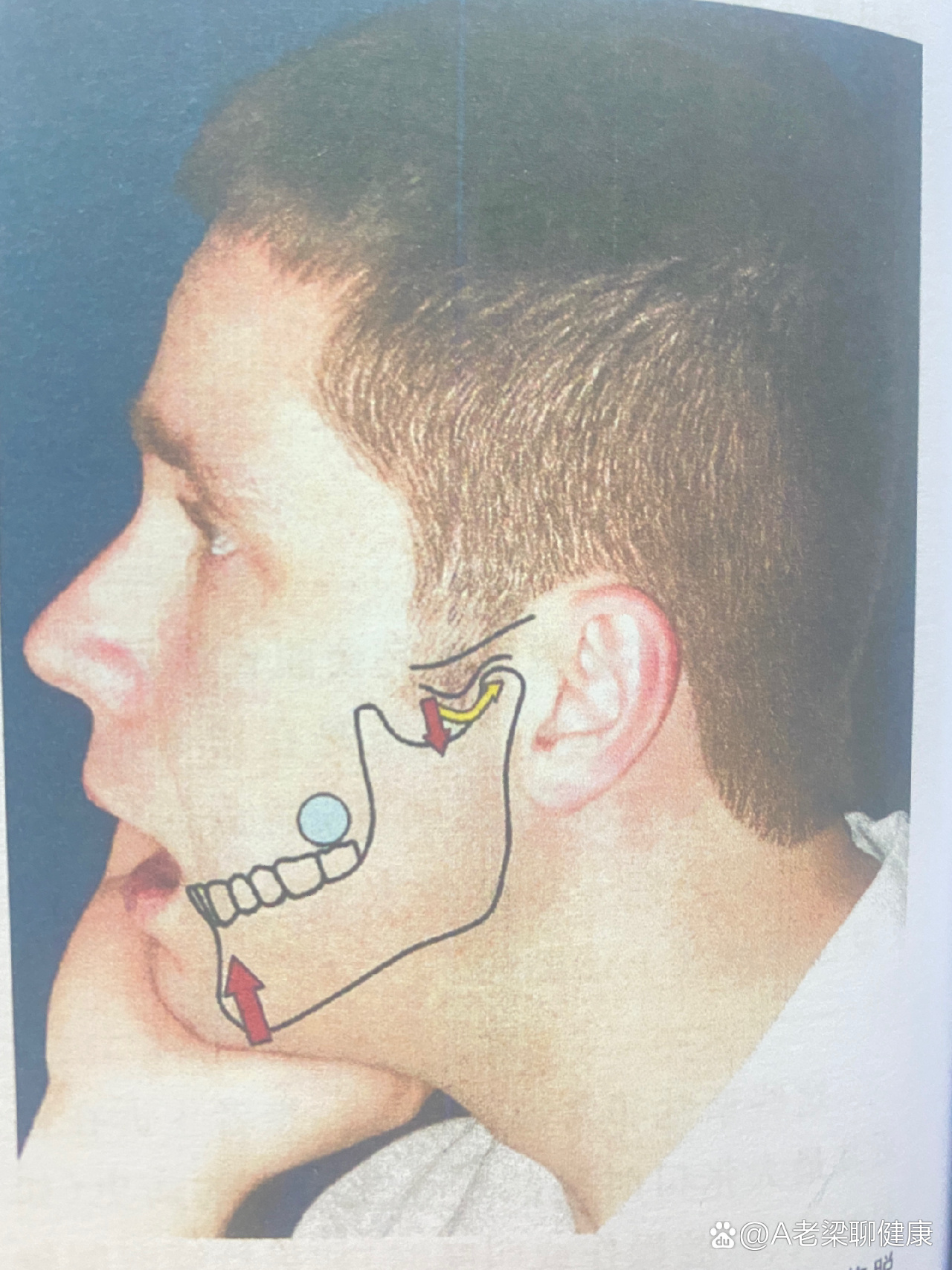 颞下颌关节紊乱张口受限