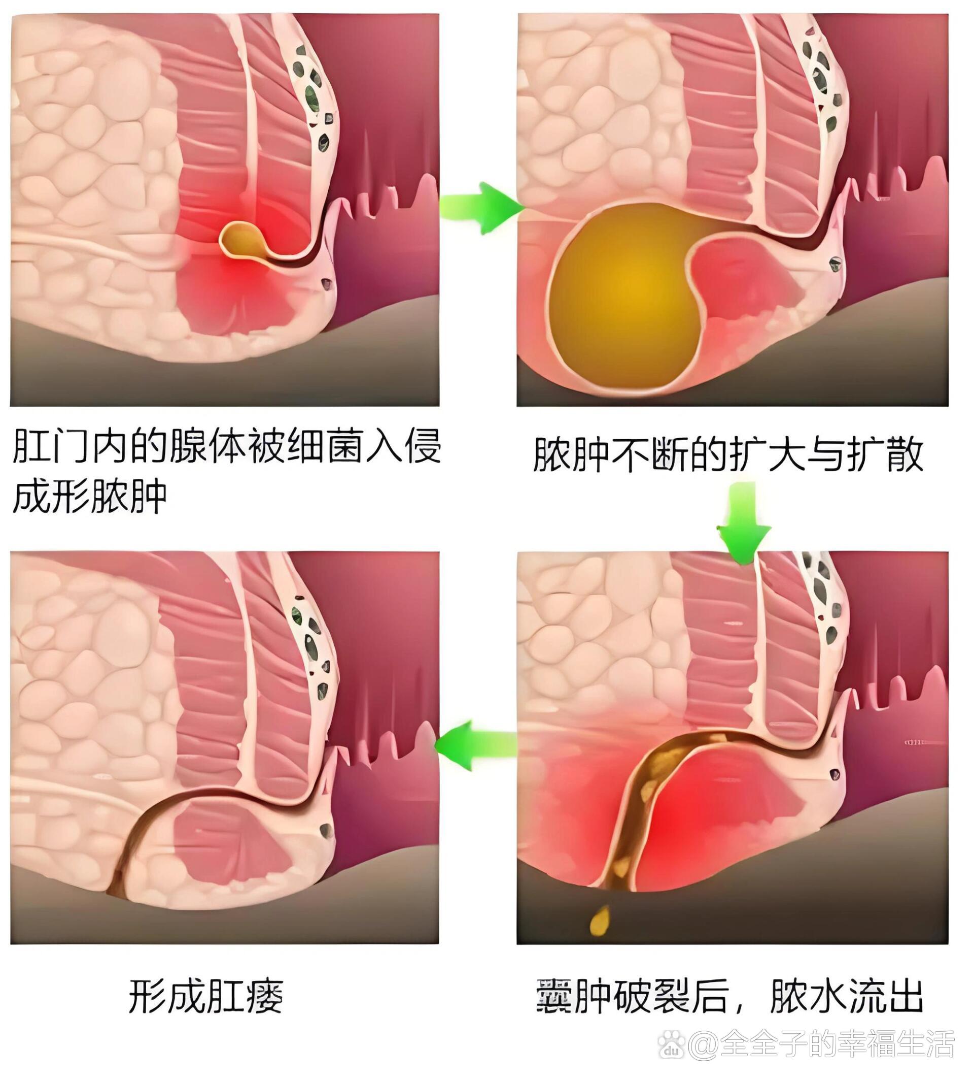 宝宝肛周脓肿图片初期图片