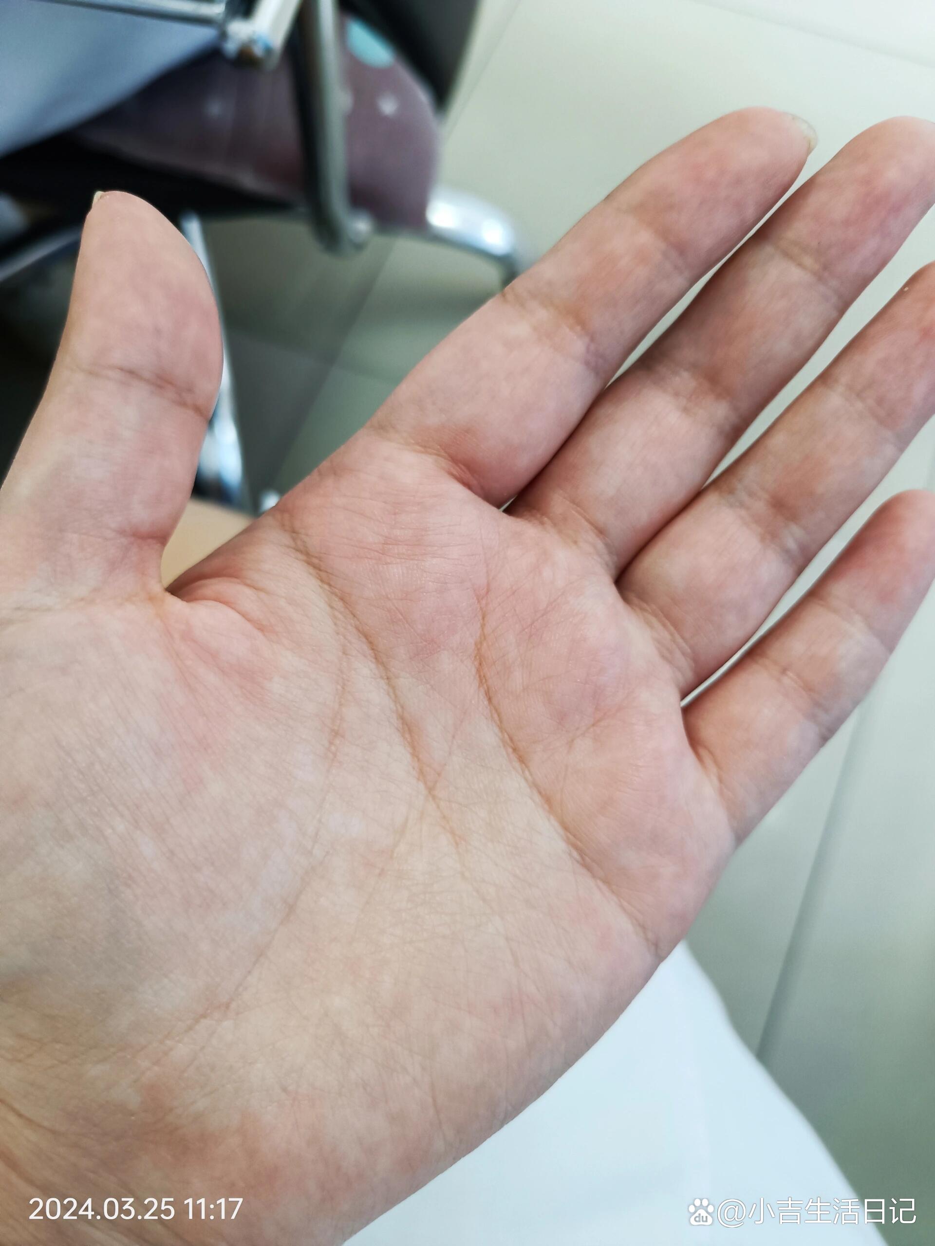 为啥有时候手心红白相间的?