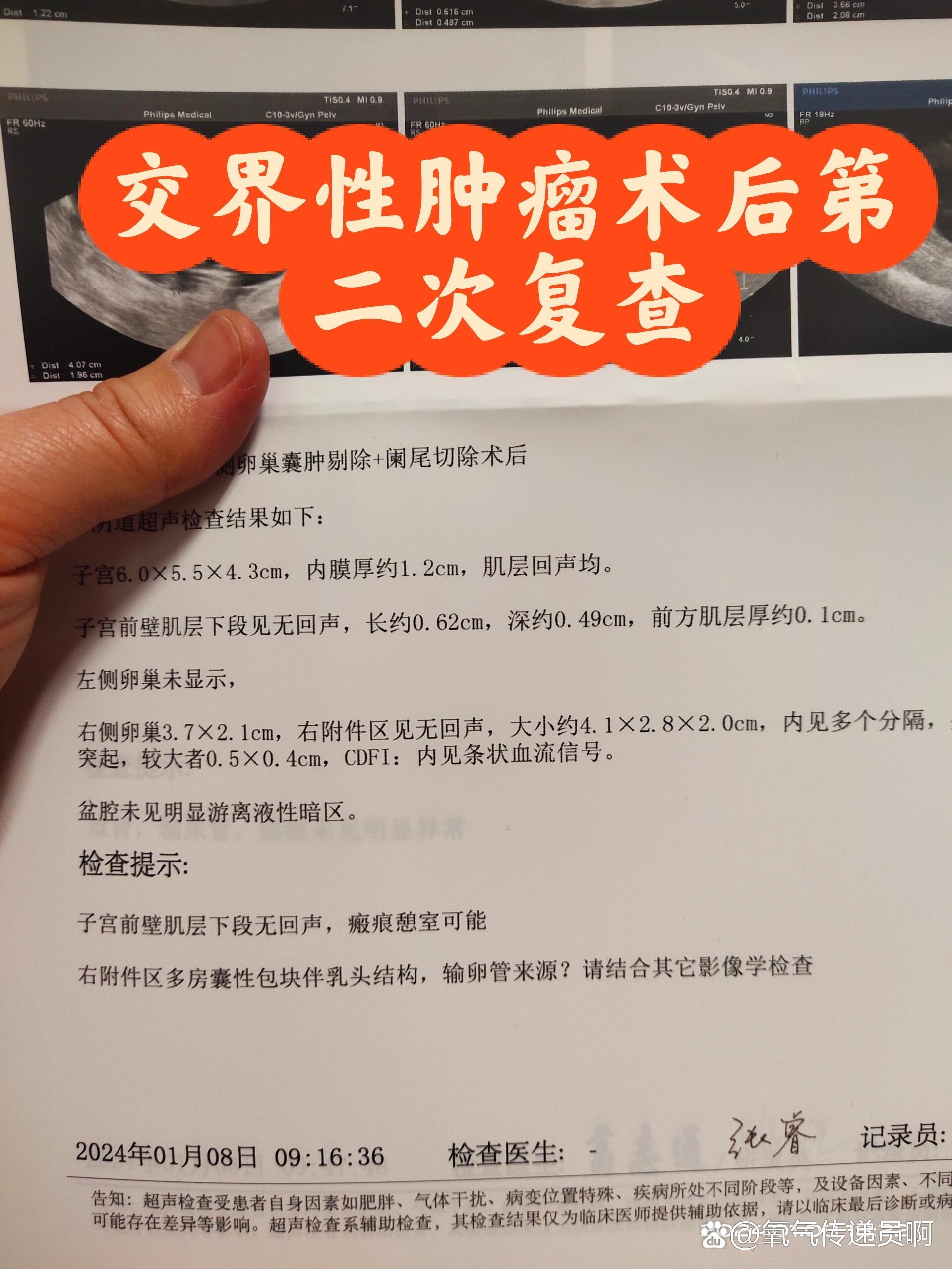 昨天,是我术后的第二次复查,检查结果不太好,显示右侧卵巢又长东西了