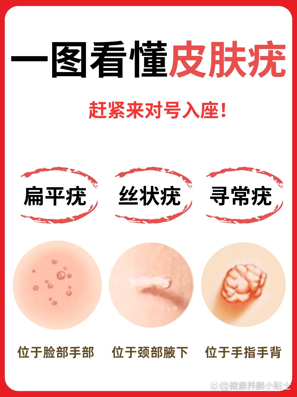 你是什么皮肤疣你真的知道吗6315快来自查6015