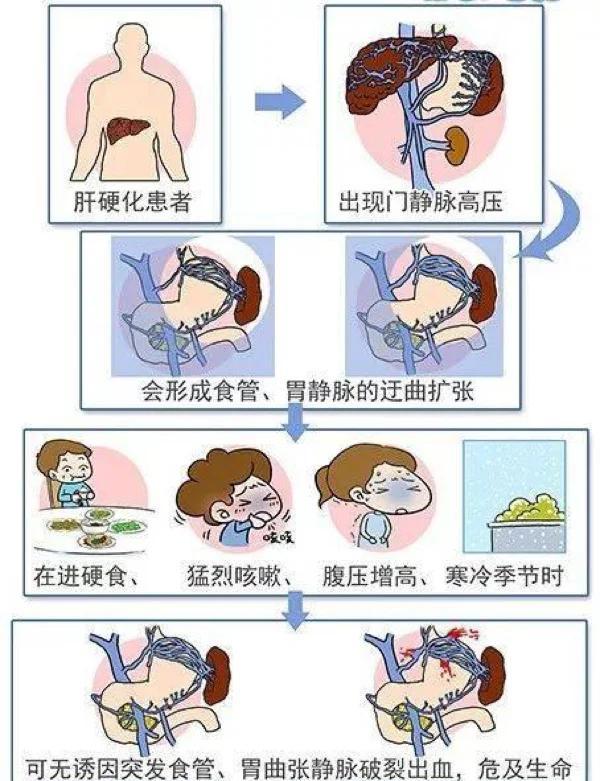 TIPS手术：肝硬化患者的新希望