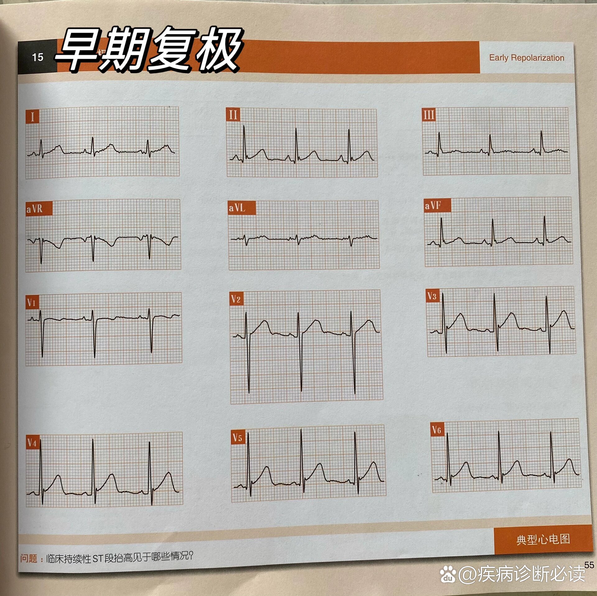 早期复极心电图图片