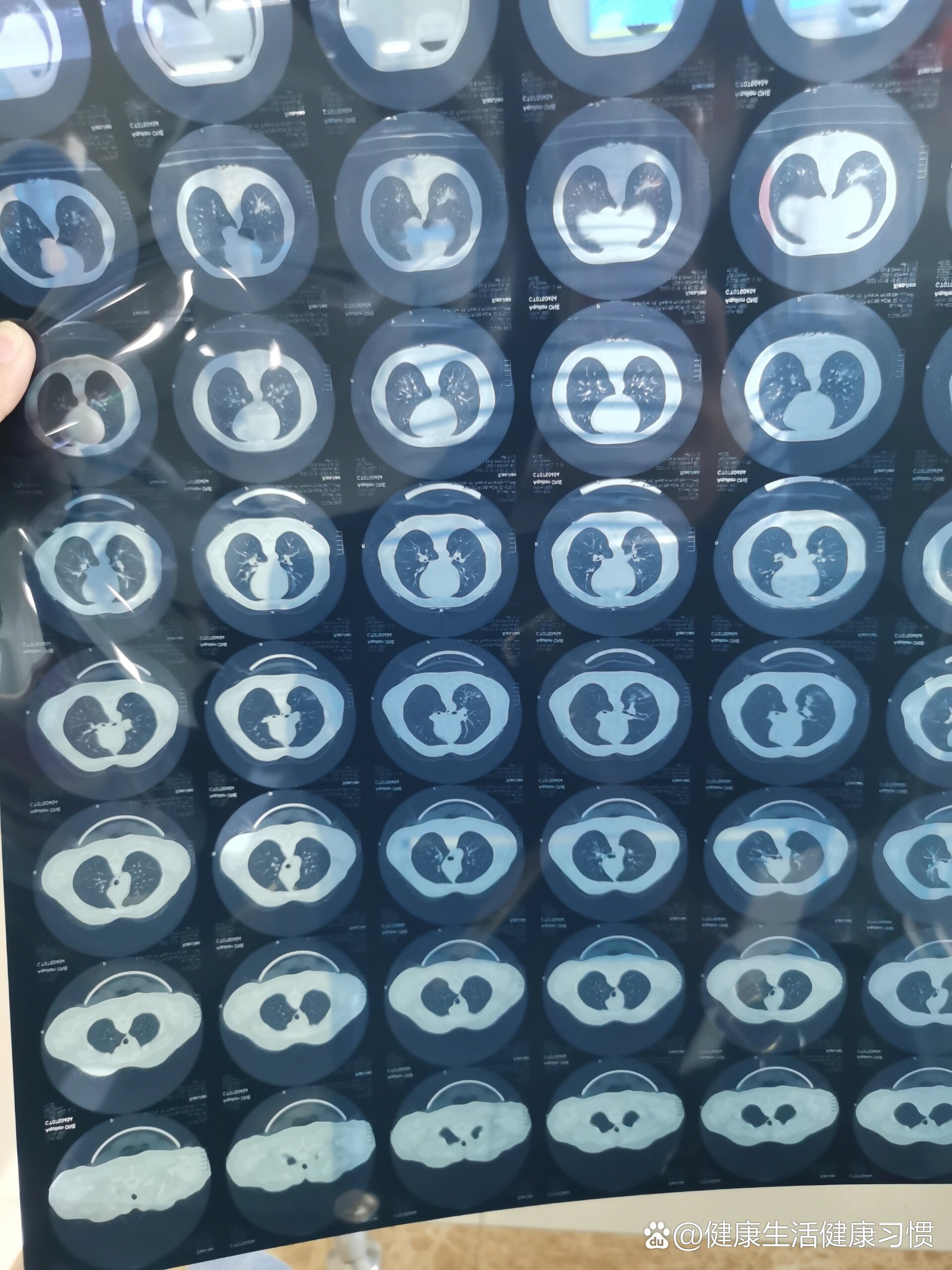 ct显示双肺下叶炎症