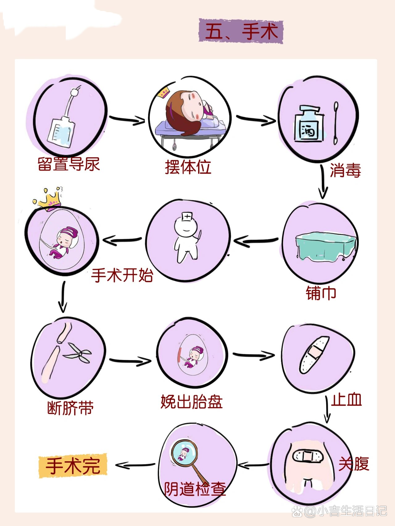 剖宫产步骤详解图解图片