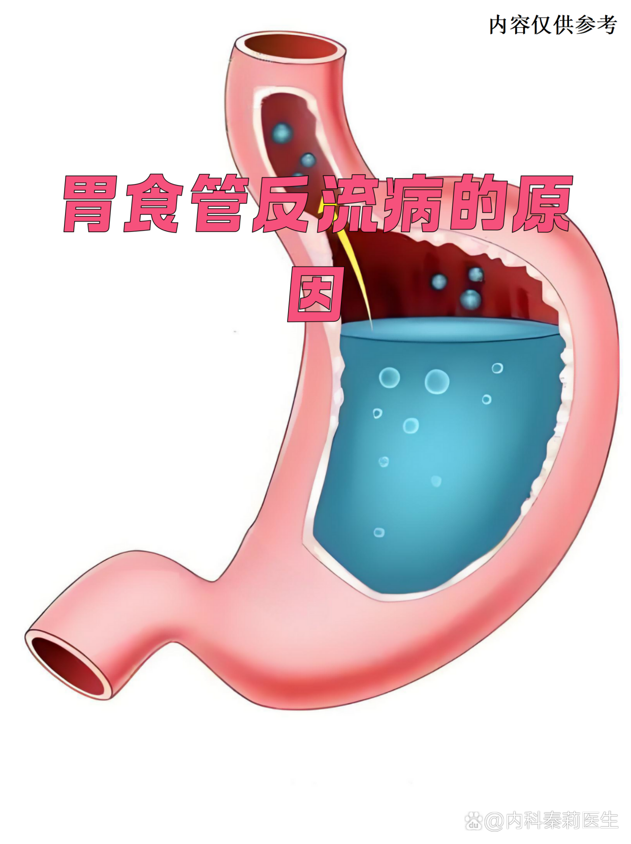 胃食管反流病的原因
