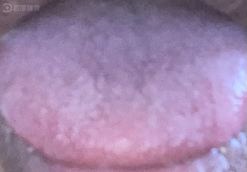 痰浊闭阻证是引起胸痹的常见原因之一-医疗科普-百度健康