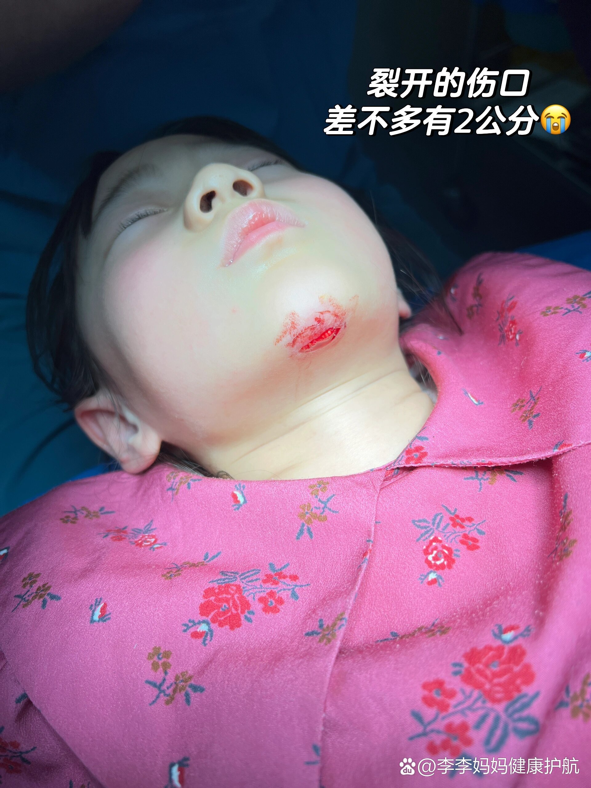女儿在家里玩椅子摔了一跤下巴缝了七针‼️